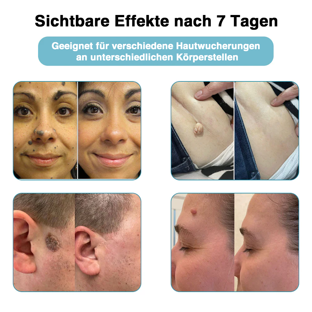🇩🇪Bikenda® VelvetSkin+ All-in-One Laser Eraser Pen (mit CO₂-Lasertechnologie - entfernt effektiv Muttermale, Warzen, Hautanhängsel, Pigmentflecken und andere Hautunreinheiten)