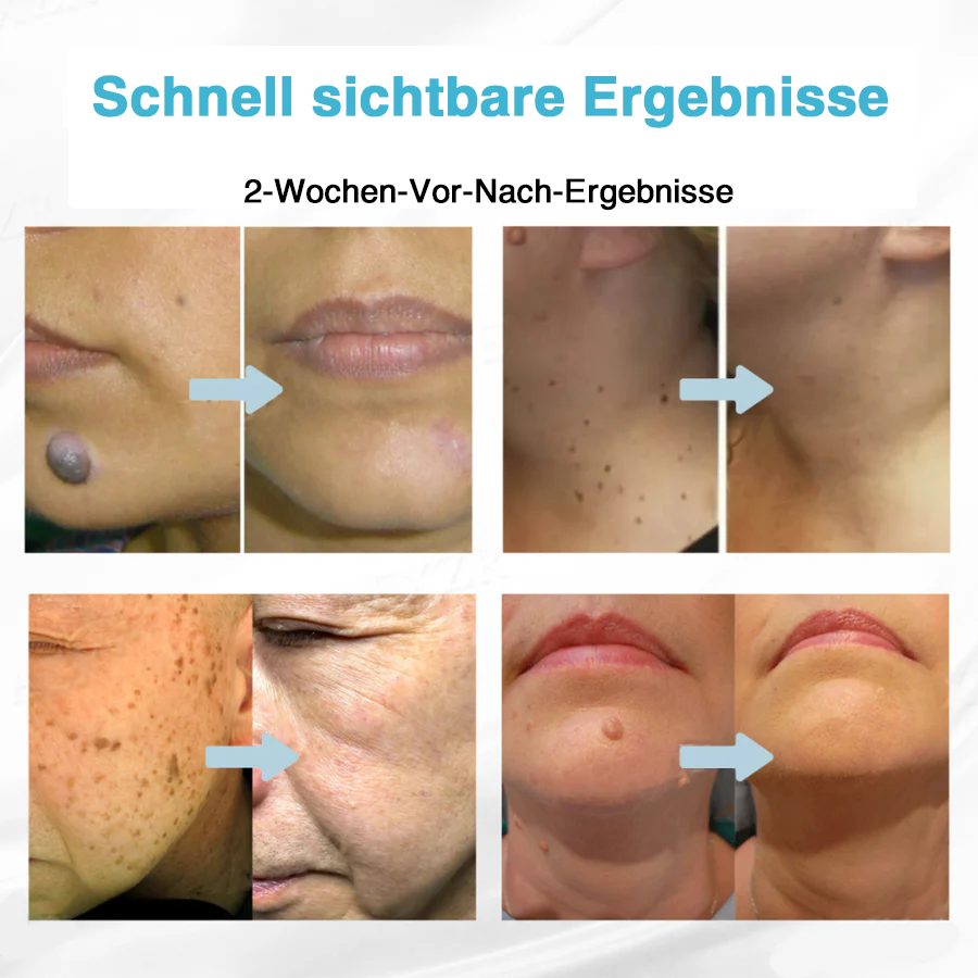 🇩🇪Bikenda® VelvetSkin+ All-in-One Laser Eraser Pen (mit CO₂-Lasertechnologie - entfernt effektiv Muttermale, Warzen, Hautanhängsel, Pigmentflecken und andere Hautunreinheiten)