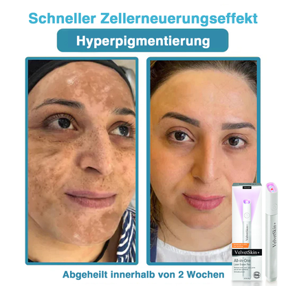 🇩🇪Bikenda® VelvetSkin+ All-in-One Laser Eraser Pen (mit CO₂-Lasertechnologie - entfernt effektiv Muttermale, Warzen, Hautanhängsel, Pigmentflecken und andere Hautunreinheiten)