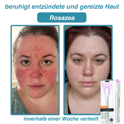 🇩🇪Bikenda® VelvetSkin+ All-in-One Laser Eraser Pen (mit CO₂-Lasertechnologie - entfernt effektiv Muttermale, Warzen, Hautanhängsel, Pigmentflecken und andere Hautunreinheiten)