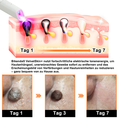 🇩🇪Bikenda® VelvetSkin+ All-in-One Laser Eraser Pen (mit CO₂-Lasertechnologie - entfernt effektiv Muttermale, Warzen, Hautanhängsel, Pigmentflecken und andere Hautunreinheiten)
